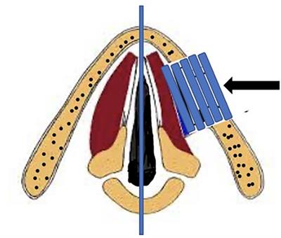 Airway management considerations in patients with vocal fold implants